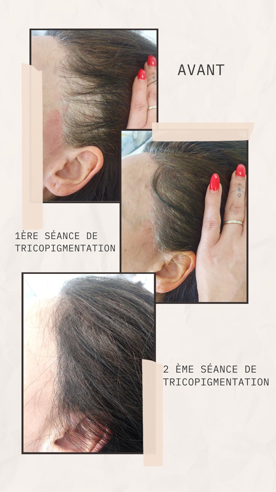 Progression d'une tricopigmentation séance après séance : avant, après la première puis après la deuxième séance